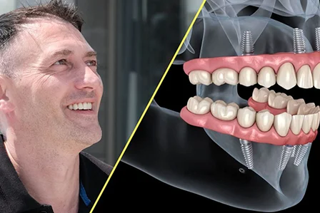 What’s in the All on 6 Implant and Is It Right for Me?