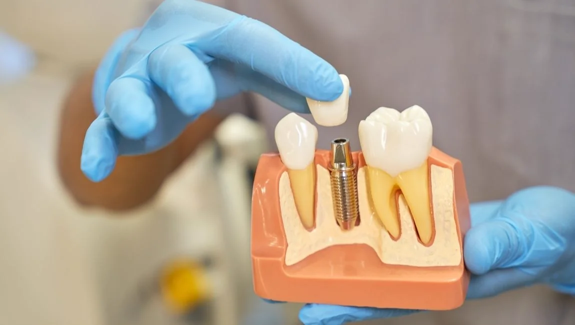 Guide to 2026 Most Important Differences for All on 4 Compared to All on 6 Dental Implants
