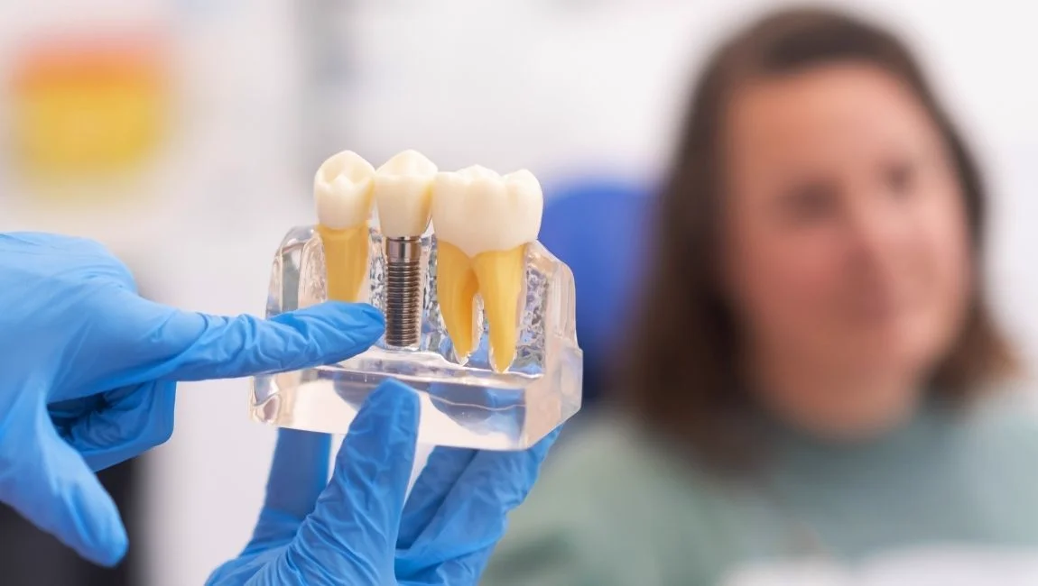 All on 4 vs Traditional Implants: Which is Better? | Nanodent Turkey Antalya