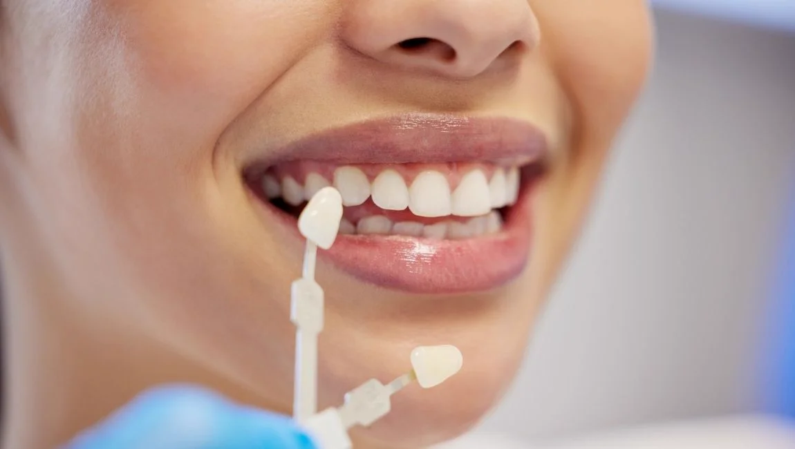 5 Advantages of Zirconium Veneers in Antalya