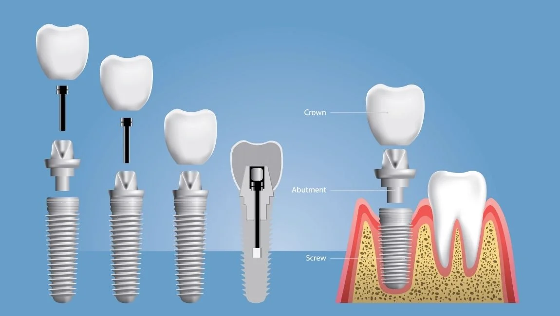 What is a Multi-Unit Abutment? How is it Made?