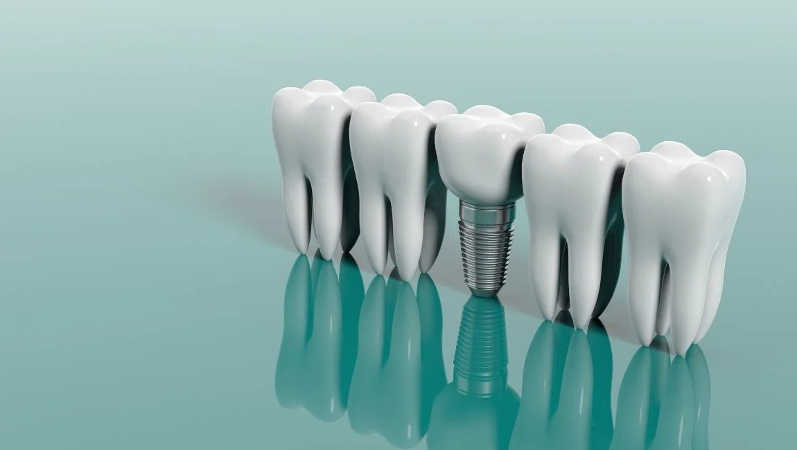 How Much Do Dental Implants Cost in Antalya? Best Place in Turkey for Teeth