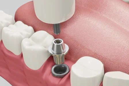 7 Advantages of Dental Implants