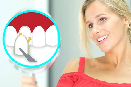 What are the different types of dental veneers?