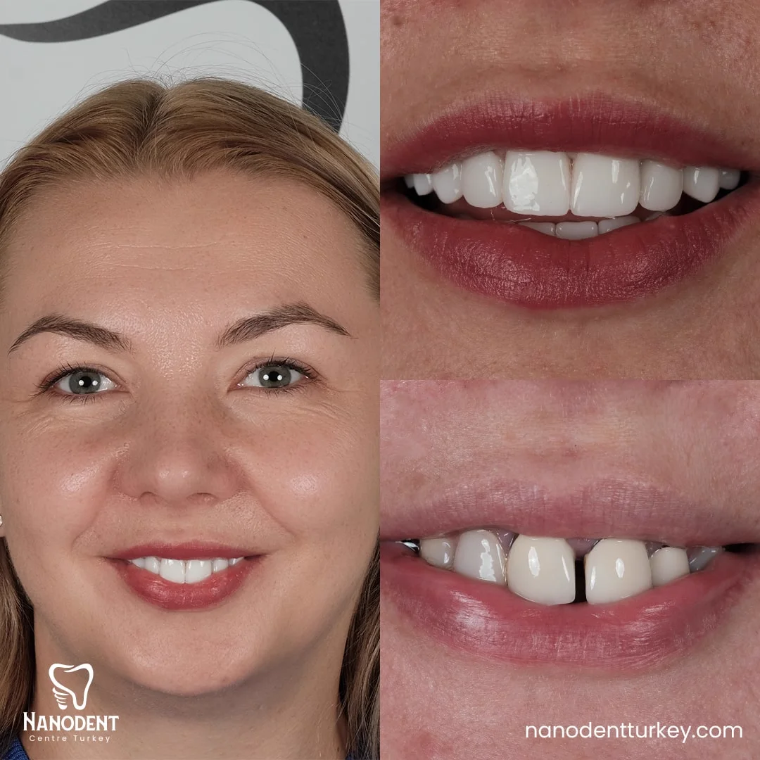 Anetta — Smile Makeover