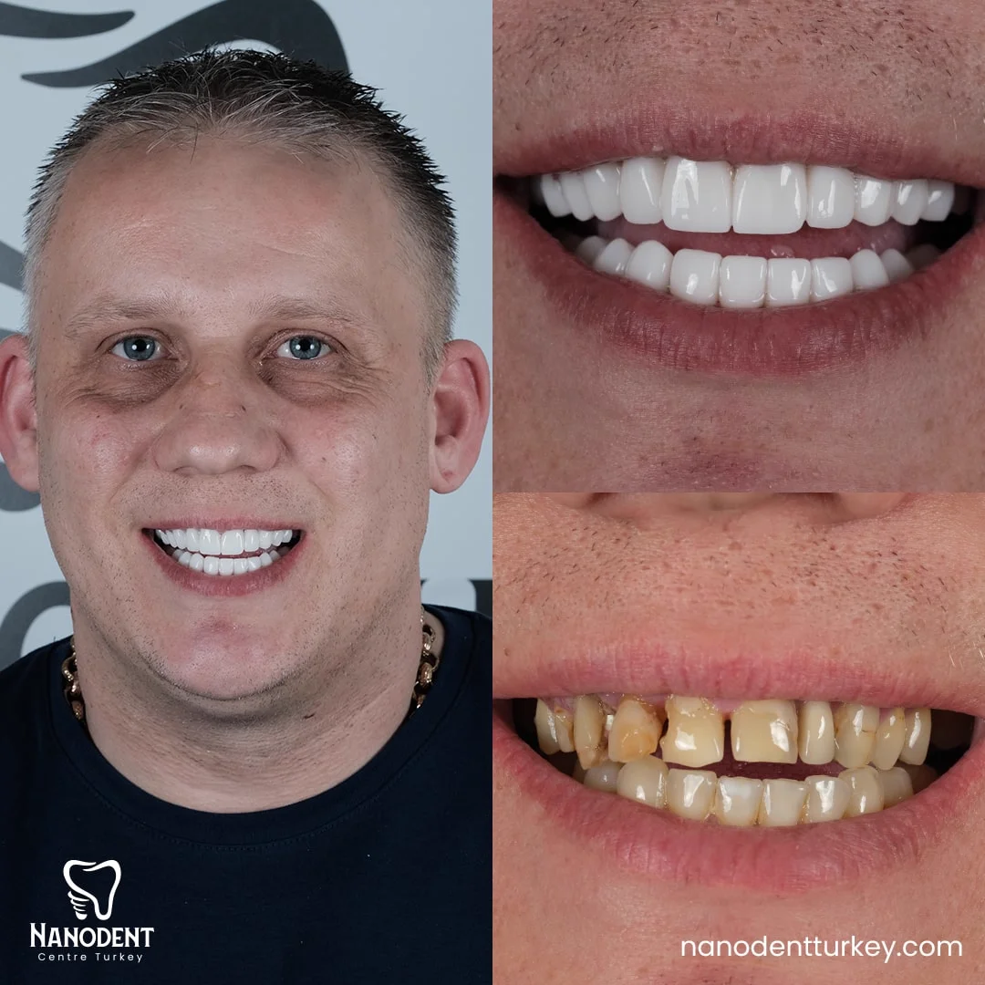 Gareth — Smile Makeover