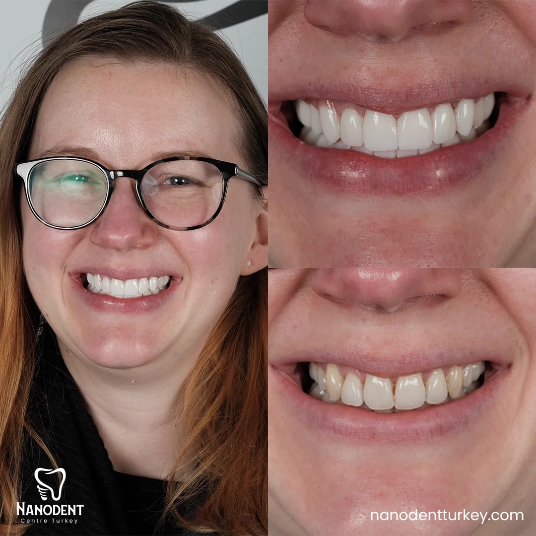 Joanne — Smile Makeover