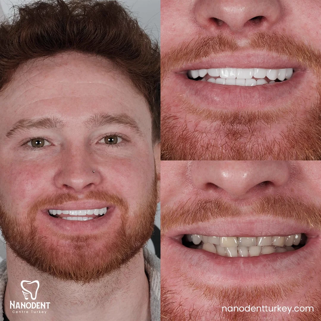 Kieran — Smile Makeover