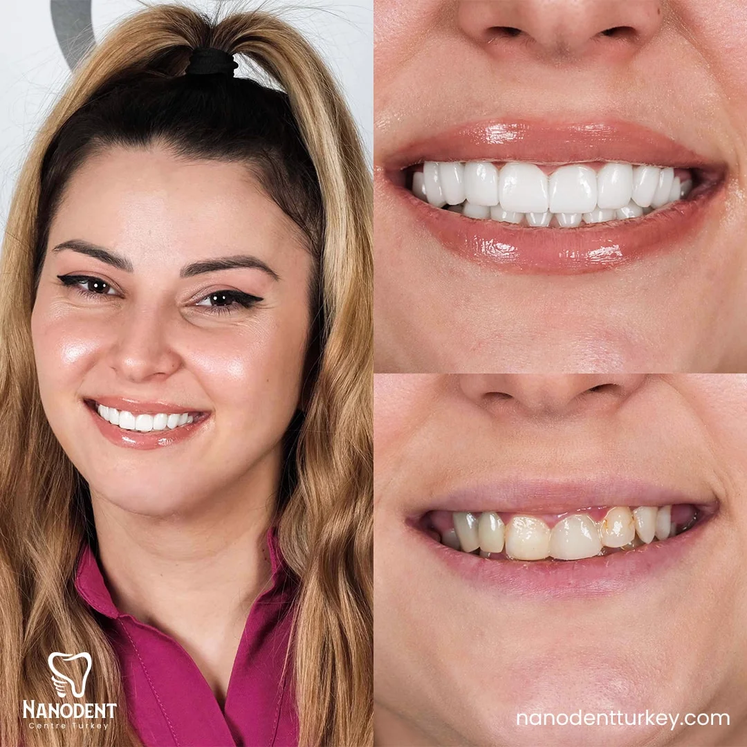 Monalisa — Smile Makeover