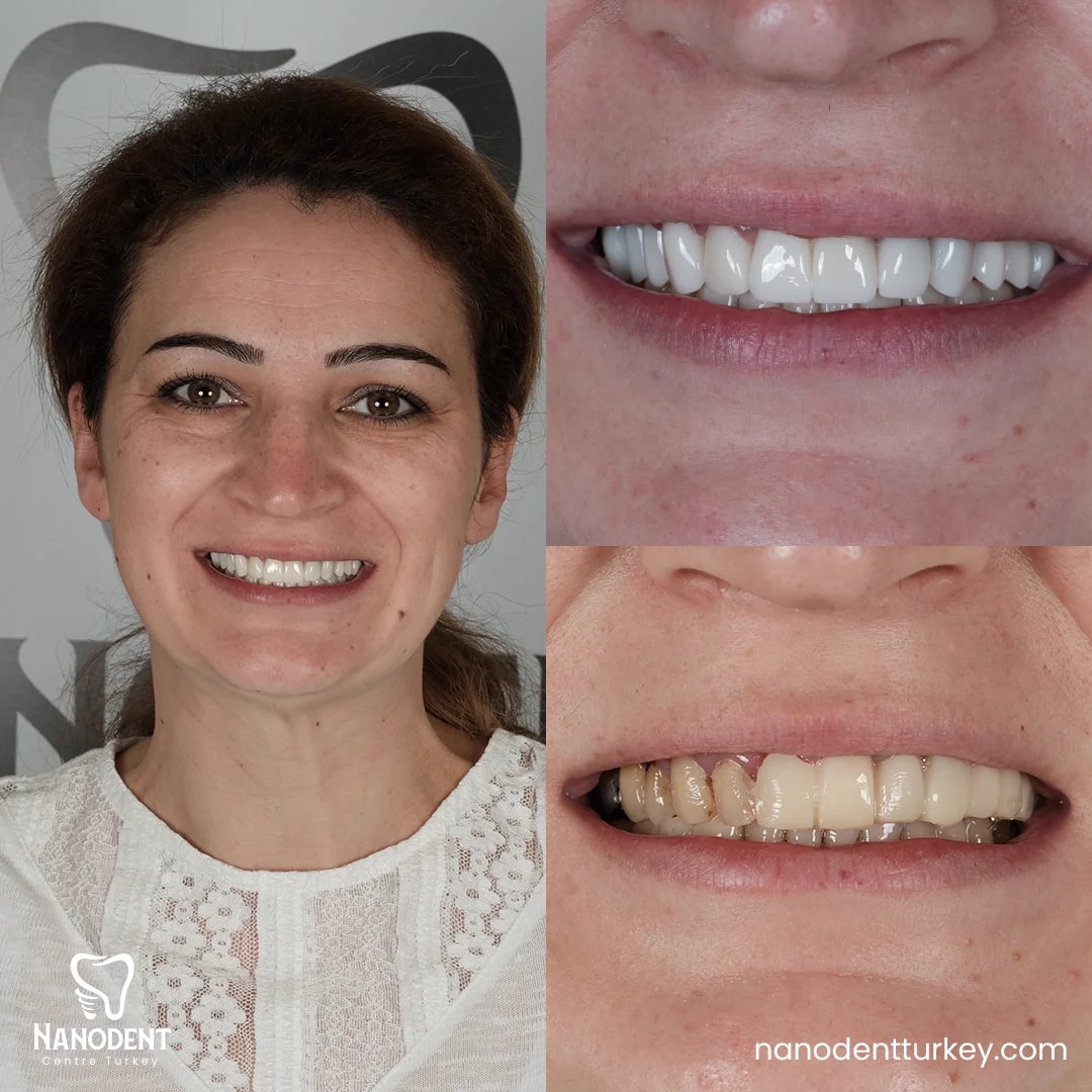 Oana — Smile Makeover