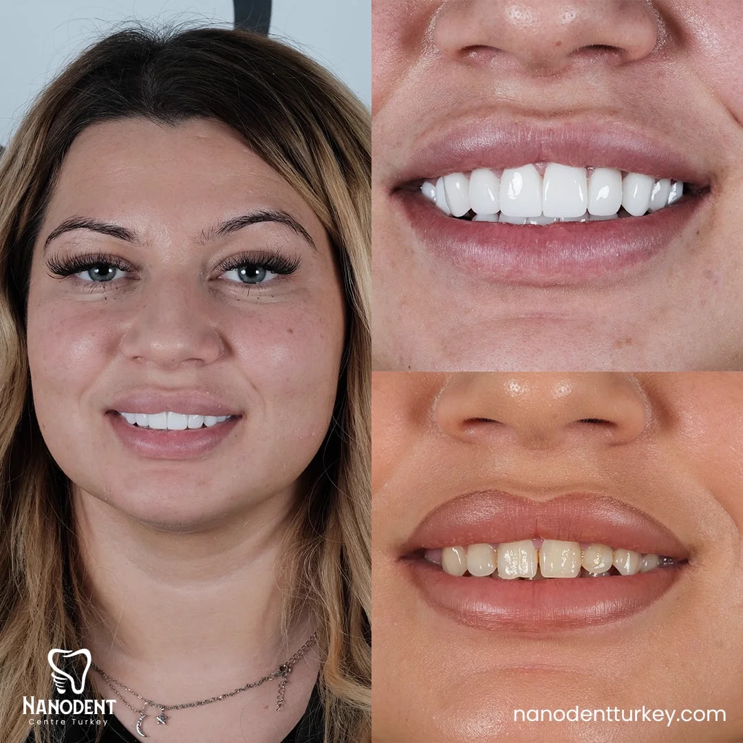 Roxana — Smile Makeover