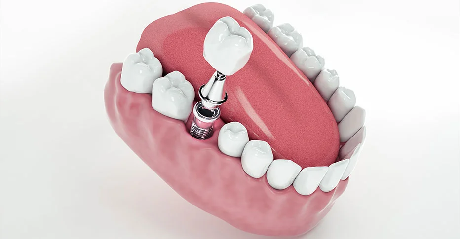 Dental Implants